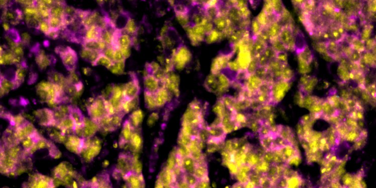 CyCIF imaging of TNBC patient derived xenografts after treatment with EZH2 and AKT inhibitors displaying expression of luminal marker CK8 (magenta) and the apoptosis marker cleaved PARP (yellow)