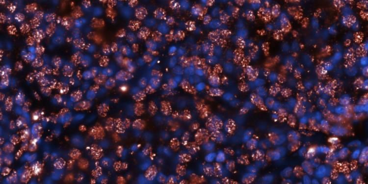 Overcoming immune evasion in solid tumours