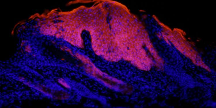 Immunofluorescence image of an early labelled lesion in red, which is derived from Lgr6+ stem cells in the skin