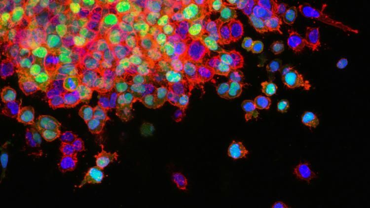 Photo by NCI Lung Cancer Metastasis