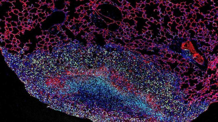 A breast cancer metastasis growing on the outside of a lung, with different colors representing different components of the tumor ecosystem.