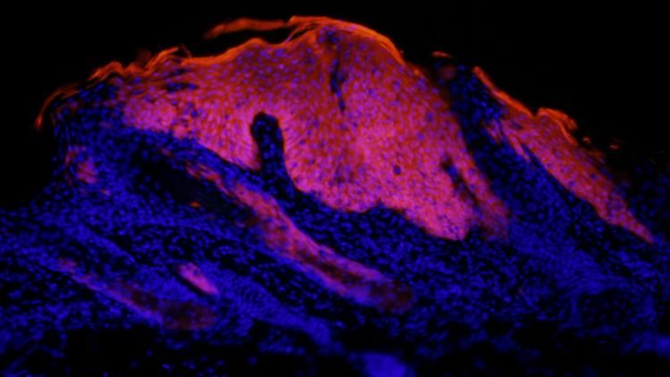 Immunofluorescence image of an early labelled lesion in red, which is derived from Lgr6+ stem cells in the skin