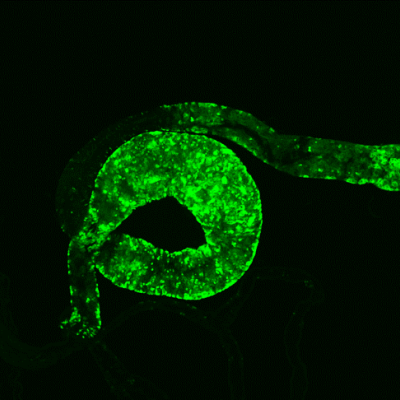 A fly gut with a tumour (green)_Perrimon lab
