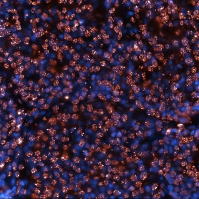 MYC multimerisation in patient tumour sections